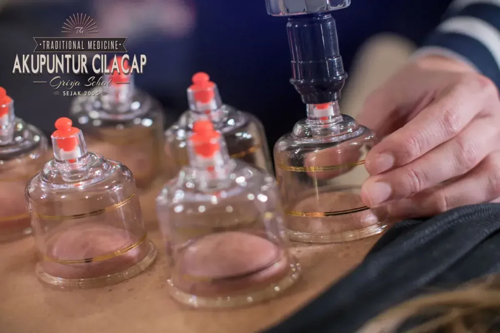 Biaya Terapi Bekam di Griya Bekam Cilacap