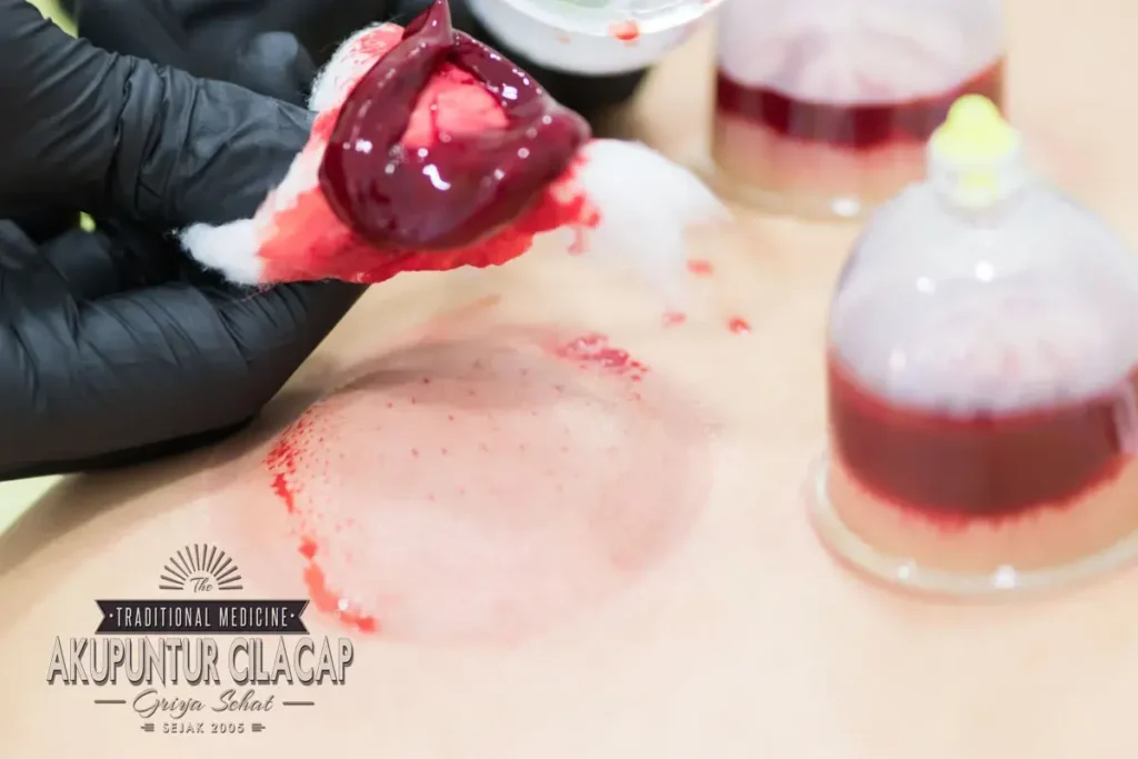 Manfaat Mengagumkan dari Terapi Bekam