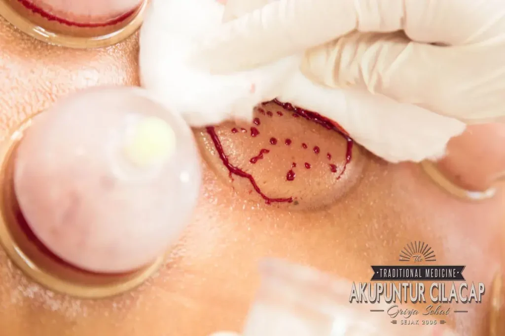 Saintifikasi dan Penelitian Terkait Bekam