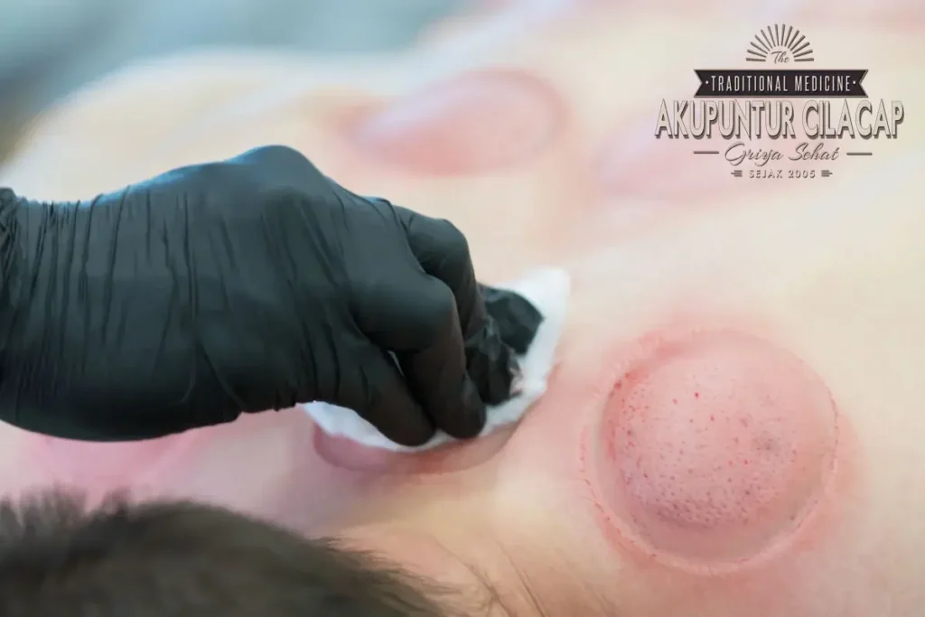 Terapi Bekam untuk Kondisi Spesifik